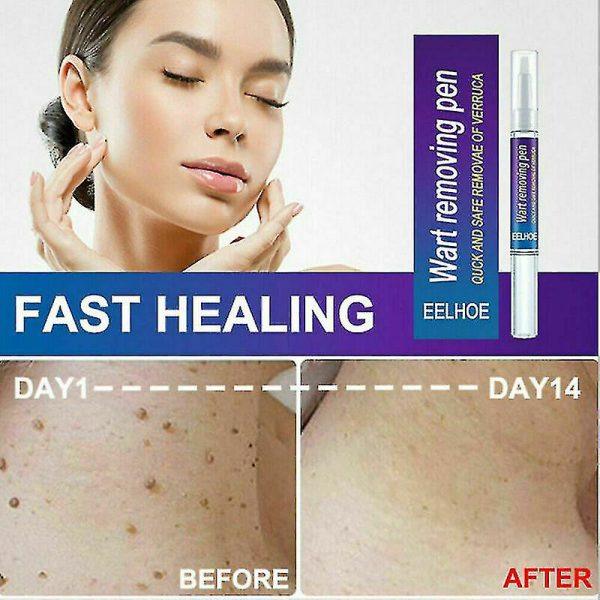 Wart Remover Gel Pen Fast & Effective
