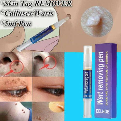 Wart Remover Gel Pen Fast & Effective